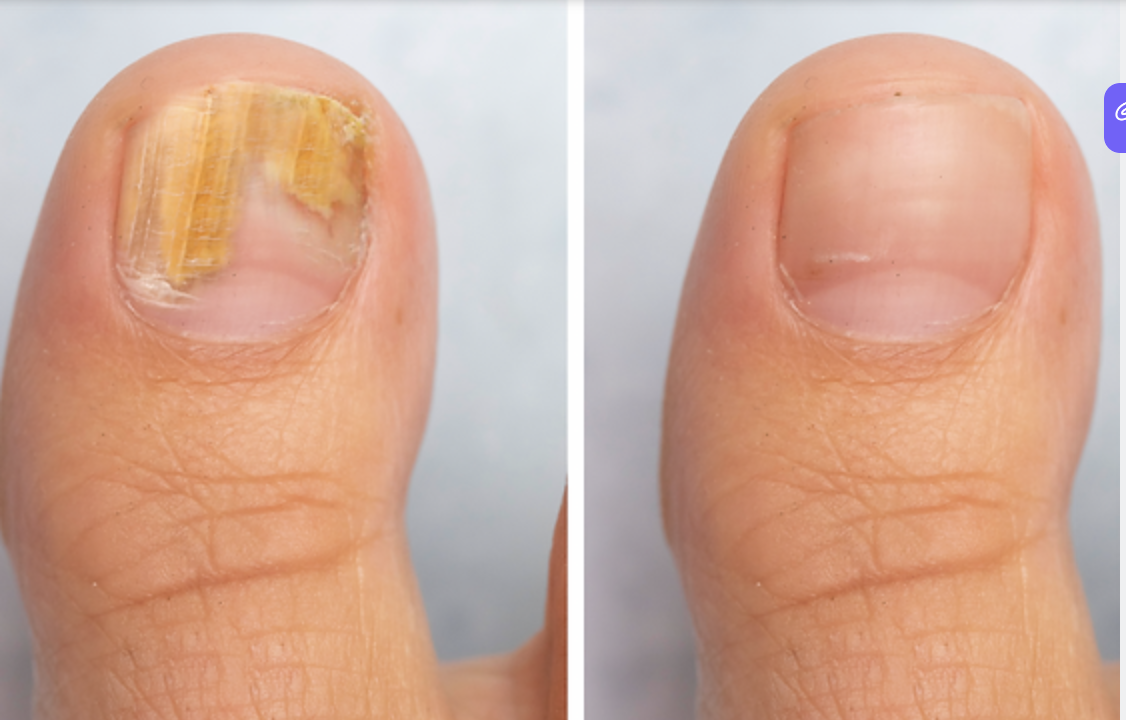 nail fungus